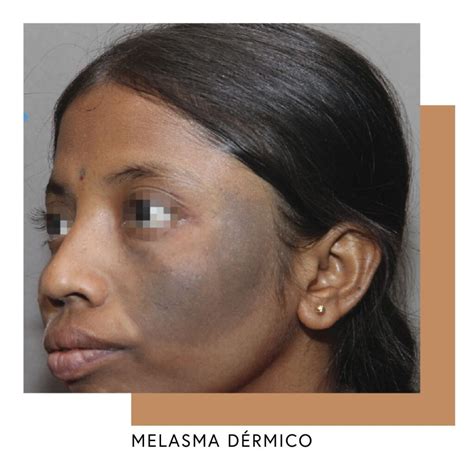 Os Tipos De Melasma Qual O Seu Ritu Ria