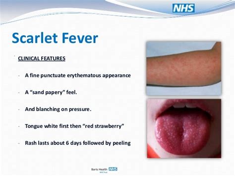 Rheumatic Fever Rash Pictures Photos