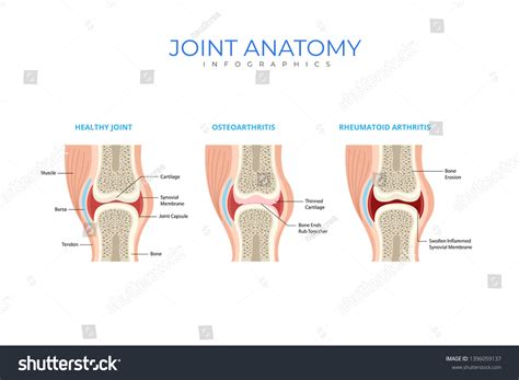 Joint Anatomy Medical Infographic Chart Composition Stock Vector ...