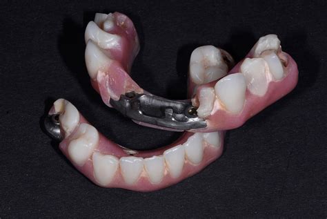 Prosthetic Complications And Survival Rates Of Metal Acrylic Implant