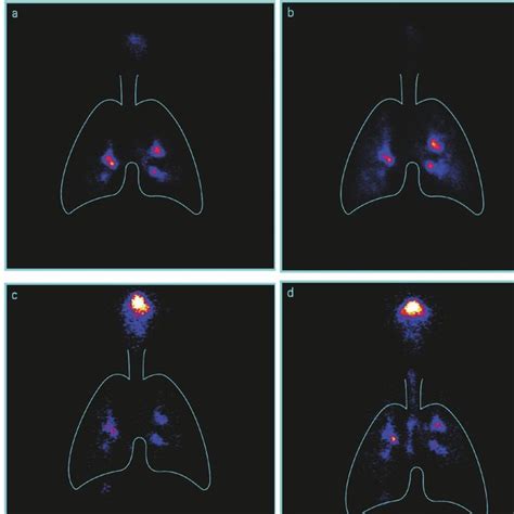 (PDF) Higher lung deposition with Respimat Soft Mist Inhaler than HFA ...