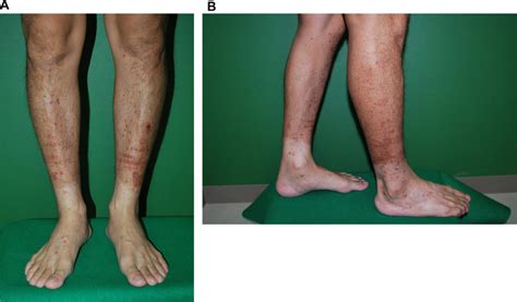 A B Palpable Purpura On The Lower Extremities Download Scientific Diagram