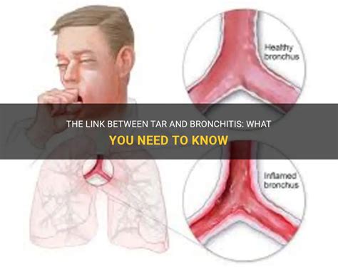 The Link Between Tar And Bronchitis What You Need To Know Medshun