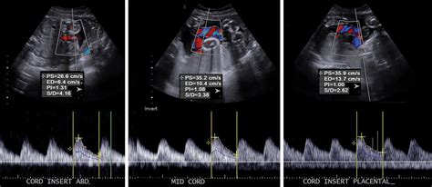 A Radiologists Guide To The Performance And Interpretation Of Obstetric Doppler Us Radiographics