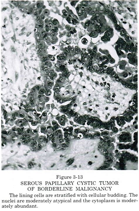 Pathology Outlines Serous Borderline Tumor Atypical Proliferative