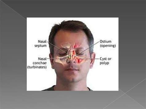 Retention Cyst Of The Maxillary Sinus Image