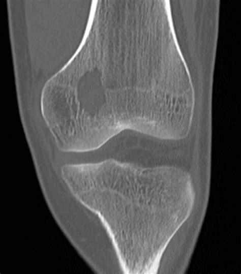 Chondroblastoma Article