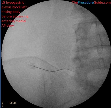 Fluoroscopic Guided Piriformis Injection Technique And Overview The