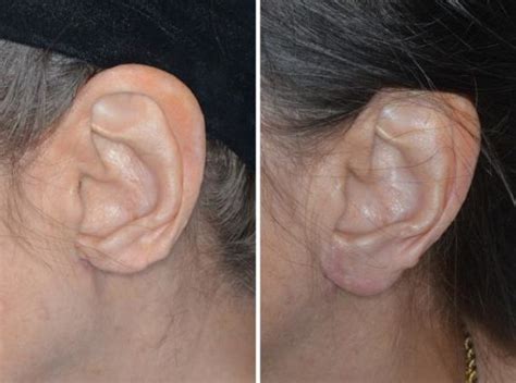 Earlobe Repair Photos Miami FL Patient 1303