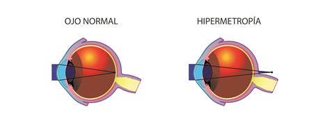 Sobre A Hipermetropia é Correto Afirmar RETOEDU