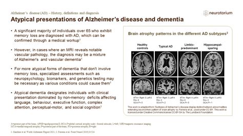 Alzheimers Disease History Definitions And Diagnosis Neurotorium