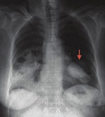 Chest X-ray showing multiple cystic lesions with left lower zone cyst ...