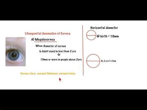 DISEASES OF CORNEA 1 CONGENITAL ANOMALIES Undergraduate Ophthalmology