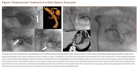 Endovascular Treatment Of Giant Visceral Aneurysms An Overview