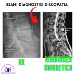 Discopatia L L O L S Protrusione Ernia Sintomi Ed Esercizi