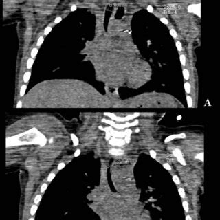 Computed Tomography Angiogram Of The Chest A Coronal View Showing A