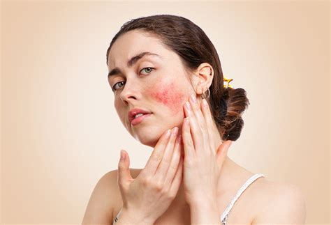 Dermatologist Recommended Treatments For Rosacea | The Well by Northwell