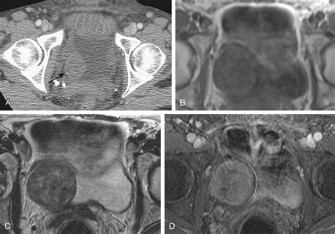 Benign And Malignant Bladder Lesions Radiology Key