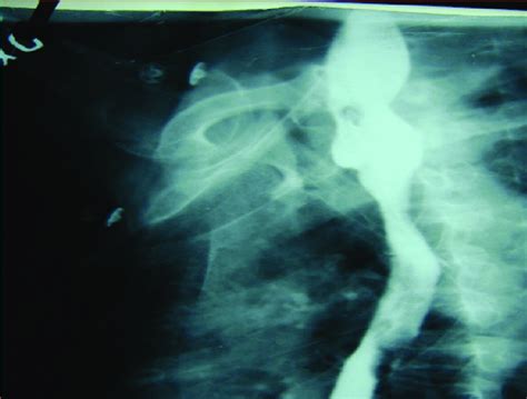 Barium Swallow Study Of The Esophagus Revealing Filling Defect On And