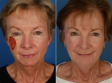 Skin Cancer Reconstruction Photos | Naples, FL | Patient 12033