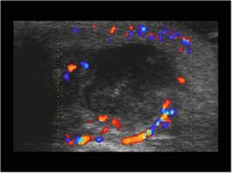 Parotid Gland Abscess Ultrasound