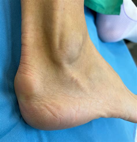 Hallux Valgus Dr Michael Vitek 1120 Wien