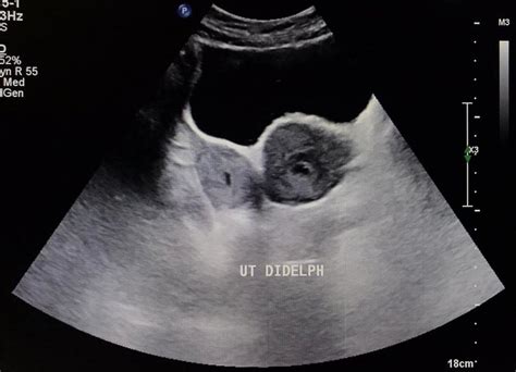 Ultrasound Showing Uterus Didelphys Postnatally On Day 7 Download