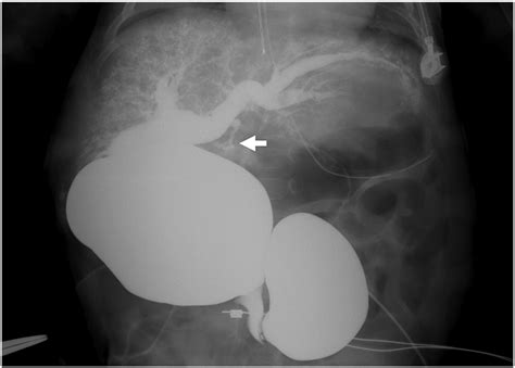 Choledochal Cyst Rupture With An Intrahepatic Pseudocyst Mimicking Hepatic Mesenchymal Hamartoma