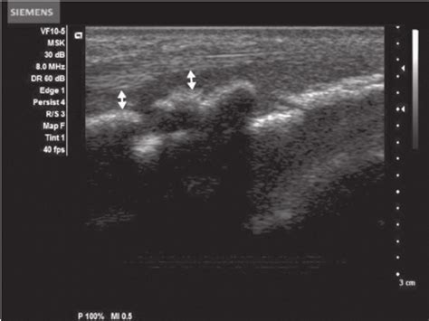 Longitudinal Us Image Of The Tibial Tuberosity With The Cartilage