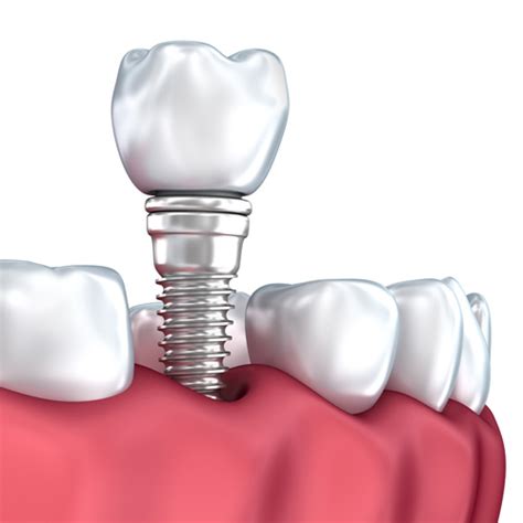 The Pros & Cons of Permanent Dentures | Molson Park Dental Office