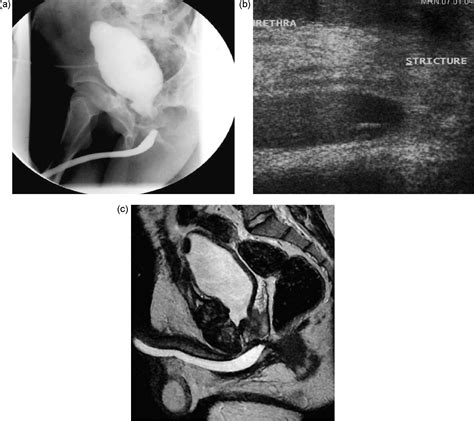 Mr Urethrogram Versus Combined Retrograde Urethrogram And