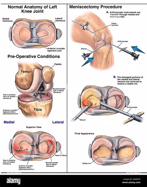 Arthroscopic Knee Surgery With Meniscectomy At Rachel Lashbrook Blog