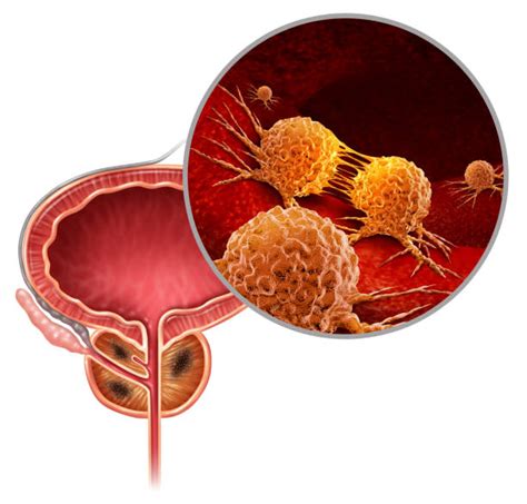 Prostate Cancer Stock Photos Pictures And Royalty Free Images Istock