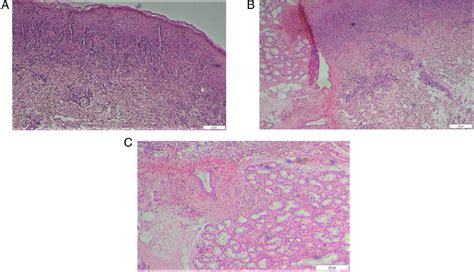 Figure 2 From Nivolumab Induced Lichenoid Granulomatous Stomatitis In A