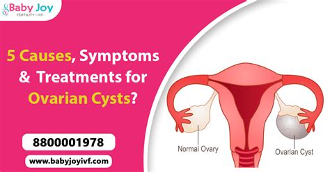 5 Causes, Symptoms & Treatments for Ovarian Cysts? By Best IVF Doctors In Delhi - Baby Joy IVF