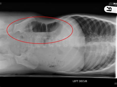 Intussusception With Spontaneous Reduction Small Bowel Small Bowel Vs