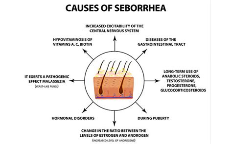 Seborrheic Dermatitis On Scalp Symptoms Causes Treatments Vedix