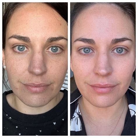 Before And After A Years Difference Rtretinoin