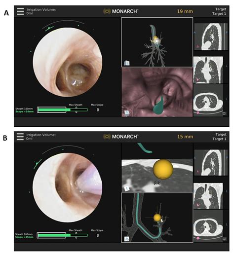 Jcm Free Full Text Lung Nodule Evaluation Using Robotic Assisted