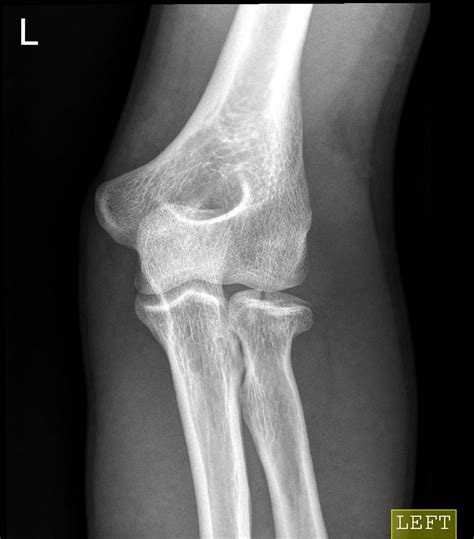 Radial Head Fracture Image Radiopaedia Org