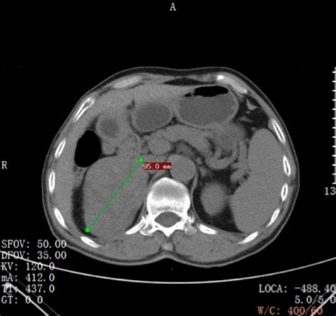 Non-contrast-enhanced CT scan showing an encapsulated large right ...