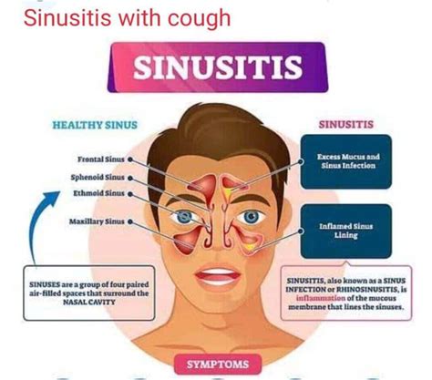 Sinusitis Headache Symptoms