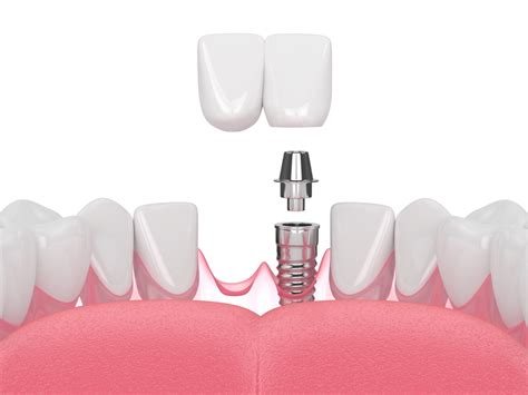 Cantilever Dental Bridge - Procedure, Pros, Cons & Costs