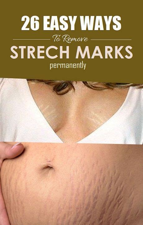 How To Get Rid Of Stretch Marks Fast And Naturally Stretch Marks