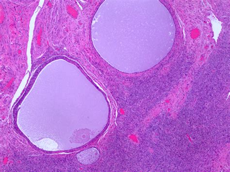 Fallopian Tube Cyst Histology