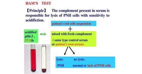 Paroxysmal Nocturnal Hemoglobinuria Pnh Medicoapps Org