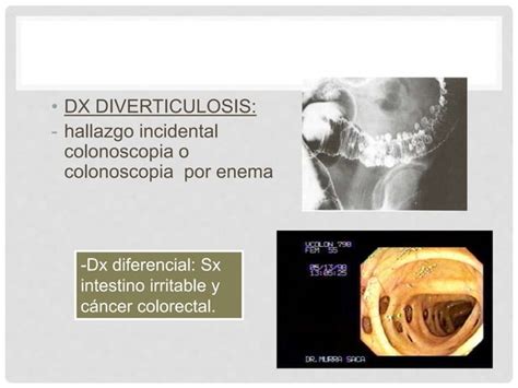 Enfermedad Diverticular Del Colon Ppt