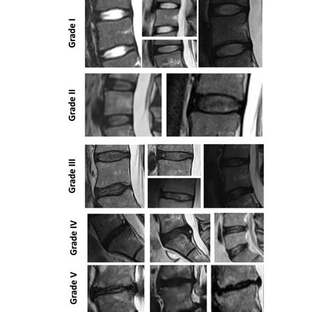 Grading Of Lumbar Disc Degeneration According To Pfirrmann Mri Based