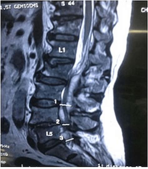 Intraoperative Picture Showing The Epidural Abscess After Opening Up