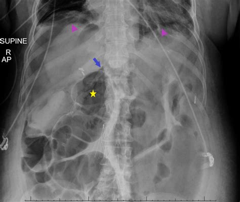 Abdominal Radiograph In A Supine Position Demonstrating Classic Signs Download Scientific